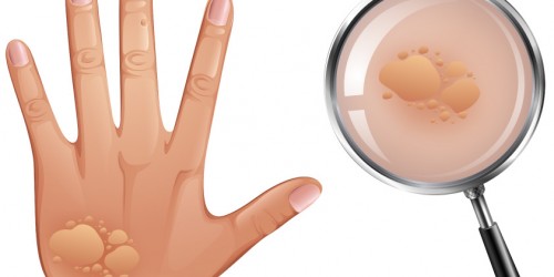 Angioedema (Giant Hives): Causes, Symptoms, Diagnosis, Treatment and Management Plan